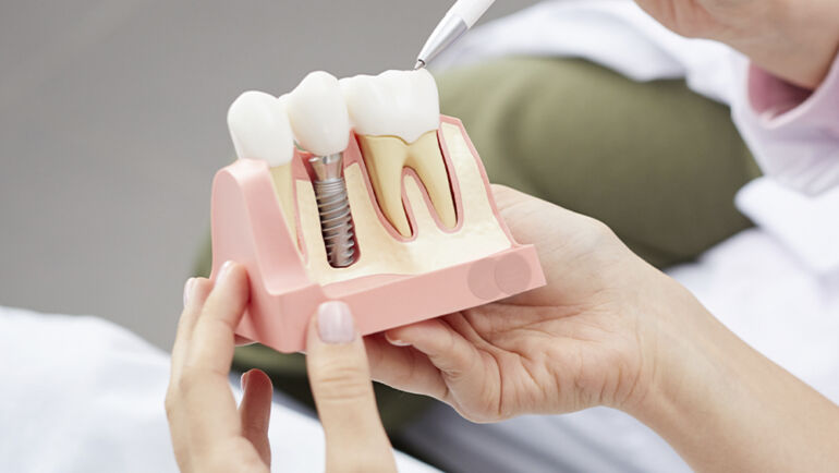 Implante dentário em um único dia é aqui, na Dentale Osasco